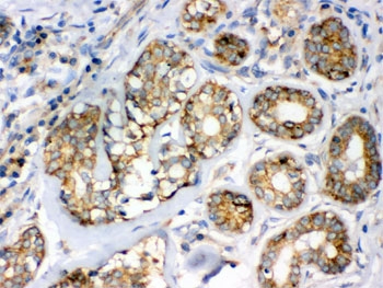 IHC testing of FFPE human breast cancer tissue with Flotillin-2 antibody. HIER: Boil the paraffin sections in pH 6, 10mM citrate buffer for 20 minutes and allow to cool prior to staining.