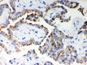 IHC testing of FFPE human lung cancer with ITPR3 antibody. HIER: Boil the paraffin sections in pH 6, 10mM citrate buffer for 20 minutes and allow to cool prior to staining.