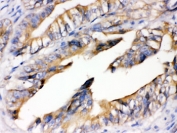 IHC testing of FFPE human intestinal cancer tissue with RAGE antibody. HIER: Boil the paraffin sections in pH 6, 10mM citrate buffer for 20 minutes and allow to cool prior to staining.