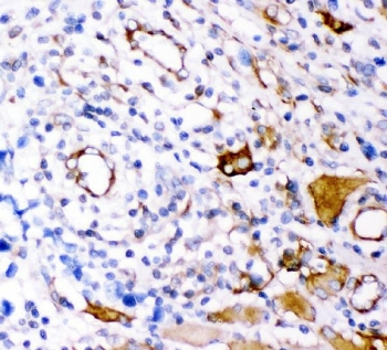 IHC testing of FFPE human lung cancer with Plectin antibody. HIER: Boil the paraffin sections in pH8 EDTA buffer for 20 minutes and allow to cool prior to staining.