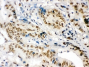 IHC testing of FFPE human intestinal cancer tissue with p54nrb antibody. HIER: Boil the paraffin sections in pH 6, 10mM citrate buffer for 20 minutes and allow to cool prior to staining.