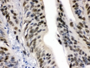 IHC testing of FFPE human intestinal cancer with DDB1 antibody. HIER: Boil the paraffin sections in pH 6, 10mM citrate buffer for 20 minutes and allow to cool prior to staining.