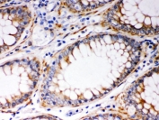 IHC testing of FFPE human intestinal cancer tissue with BAK antibody. HIER: Boil the paraffin sections in pH 6, 10mM citrate buffer for 20 minutes and allow to cool prior to staining.