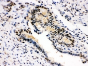 IHC testing of FFPE human breast cancer with SMN1/2 antibody. HIER: Boil the paraffin sections in pH 6, 10mM citrate buffer for 20 minutes and allow to cool prior to staining.