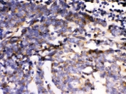 IHC testing of FFPE human lung cancer with MAPK6 antibody. HIER: Boil the paraffin sections in pH 6, 10mM citrate buffer for 20 minutes and allow to cool prior to staining.