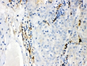 IHC testing of FFPE human liver cancer tissue with CYP1B1 antibody. HIER: Boil the paraffin sections in pH 6, 10mM citrate buffer for 20 minutes and allow to cool prior to staining.