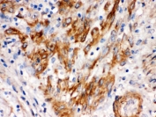 IHC testing of FFPE human endometrial carcinoma with SFRP4 antibody. HIER: Boil the paraffin sections in pH 6, 10mM citrate buffer for 20 minutes and allow to cool prior to staining.