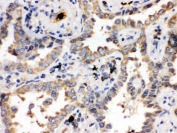 IHC testing of FFPE human lung cancer with ULK3 antibody. HIER: Boil the paraffin sections in pH 6, 10mM citrate buffer for 20 minutes and allow to cool prior to staining.