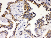 IHC testing of FFPE human lung cancer tissue with ATG14L antibody. HIER: Boil the paraffin sections in pH 6, 10mM citrate buffer for 20 minutes and allow to cool prior to staining.
