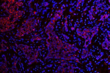 Immunofluorescent staining of FFPE human lung cancer tissue with ATG14L antibody (red) and DAPI nuclear stain (blue). HIER: steam section in pH8 EDTA buffer for 20 min.