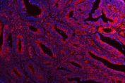 Immunofluorescent staining of FFPE human colon cancer tissue with ATG14L antibody (red) and DAPI nuclear stain (blue). HIER: steam section in pH8 EDTA buffer for 20 min.