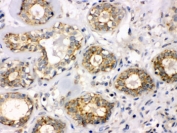 IHC testing of FFPE human breast cancer tissue with B3GNT8 antibody. HIER: Boil the paraffin sections in pH 6, 10mM citrate buffer for 20 minutes and allow to cool prior to staining.