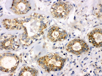 IHC testing of FFPE human breast cancer tissue with B3GNT8 antibody. HIER: Boil the paraffin sections in pH 6, 10mM citrate buffer fo