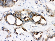 IHC testing of FFPE human lung cancer with STING antibody. HIER: Boil the paraffin sections in pH 6, 10mM citrate buffer for 20 minutes and allow to cool prior to staining.