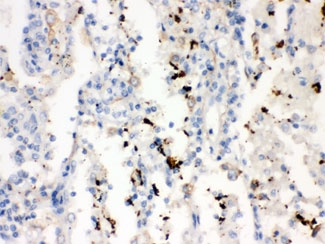 IHC testing of FFPE human lung cancer with SFTPA1/2 antibody. HIER: Boil the paraffin sections in pH 6, 10mM citrate buffer for 20 minutes and allow to cool prior to staining.