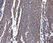 IHC staining of FFPE human squamous cell carcinoma of cervix tissue with TRPM4 antibody. HIER: boil tissue sections in pH8 EDTA for 20 min and allow to cool before testing.
