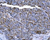 IHC staining of FFPE human prostate cancer tissue with TRPM4 antibody. HIER: boil tissue sections in pH8 EDTA for 20 min and allow to cool before testing.