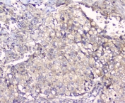 IHC staining of FFPE human lung tissue with ALIX antibody. HIER: boil tissue sections in pH6 citrate buffer for 20 min and allow to cool before testing.
