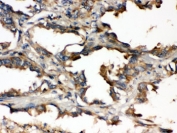 IHC testing of FFPE human lung cancer tissue with UBE2Q2 antibody. HIER: Boil the paraffin sections in pH 6, 10mM citrate buffer for 20 minutes and allow to cool prior to staining.