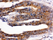 IHC testing of FFPE human intestinal cancer tissue with UPF1 antibody. HIER: Boil the paraffin sections in pH8 EDTA buffer for 20 minutes and allow to cool prior to staining.