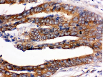 IHC testing of FFPE human intestinal cancer tissue with UPF1 antibody. HIER: Boil the paraffin sections in pH 6, 10mM citrate buffer for 20 minutes and allow to cool prior to staining.