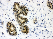 IHC testing of FFPE human breast cancer with JAB1 antibody. HIER: Boil the paraffin sections in pH 6, 10mM citrate buffer for 20 minutes and allow to cool prior to staining.