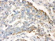 IHC testing of FFPE human lung cancer tissue with WNT2B antibody. HIER: Boil the paraffin sections in pH 6, 10mM citrate buffer for 20 minutes and allow to cool prior to staining.