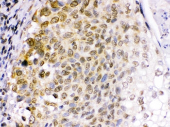 IHC testing of FFPE human lung cancer tissue with EME1 antibody. HIER: Boil the paraffin sections in pH 6, 10mM citrate buffer for 20 minutes and allow to cool prior to staining.
