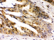 IHC testing of FFPE human intestinal cancer tissue with UHRF2 antibody. HIER: Boil the paraffin sections in pH 6, 10mM citrate buffer for 20 minutes and allow to cool prior to staining.
