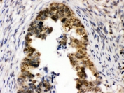 IHC testing of FFPE human intestinal cancer tissue with UHRF1 antibody. HIER: Boil the paraffin sections in pH 6, 10mM citrate buffer for 20 minutes and allow to cool prior to staining.
