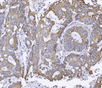 IHC staining of FFPE human colonic adenoma cancer tissue with ATX2 antibody. HIER: boil tissue sections in pH8 EDTA for 20 min and allow to cool before testing.
