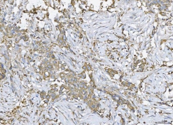 IHC staining of FFPE human breast cancer tissue with ATX2 antibody. HIER: boil tissue sections in pH8 EDTA for 20 min and allow to cool before testing.