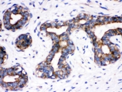 IHC testing of FFPE human breast cancer wtih CDC6 antibody. HIER: Boil the paraffin sections in pH 6, 10mM citrate buffer for 20 minutes and allow to cool prior to staining.