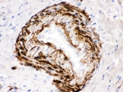 IHC testing of FFPE human intestinal cancer tissue with SMYD3 antibody. HIER: Boil the paraffin sections in pH 6, 10mM citrate buffer for 20 minutes and allow to cool prior to staining.