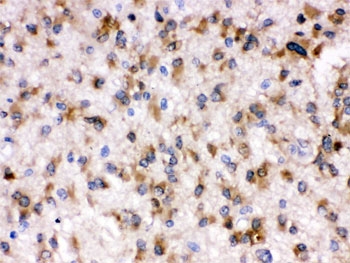IHC testing of FFPE human glioma tissue with Otoferlin antibody. HIER: Boil the paraffin sections in pH 6, 10mM citrate buffer for 20 minutes and allow to cool prior to staining.