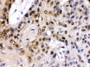 IHC testing of FFPE human esophagus squamous cell carcinoma tissue with TCF7L1 antibody. HIER: Boil the paraffin sections in pH 6, 10mM citrate buffer for 20 minutes and allow to cool prior to staining.