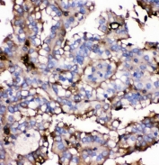 IHC staining of FFPE human renal cancer with GLUT9 antibody. HIER: boil tissue sections in pH6, 10mM citrate buffer, for 20 min and allow to cool before testing.