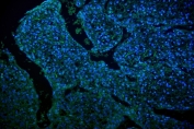 Immunofluorescent staining of human liver cancer with GLUT9 antibody (green) and DAPI (blue).