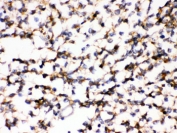 IHC testing of FFPE human glioma with KChIP2 antibody. HIER: Boil the paraffin sections in pH 6, 10mM citrate buffer for 20 minutes and allow to cool prior to staining.