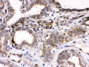 IHC testing of FFPE human breast cancer tissue with PARVA antibody. HIER: Boil the paraffin sections in pH 6, 10mM citrate buffer for 20 minutes and allow to cool prior to staining.