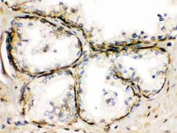 IHC testing of FFPE human prostate cancer tissue with TRPM5 antibody. HIER: Boil the paraffin sections in pH 6, 10mM citrate buffer for 20 minutes and allow to cool prior to staining.