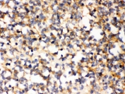 IHC testing of FFPE human glioma tissue with PAK5 antibody. HIER: Boil the paraffin sections in pH 6, 10mM citrate buffer for 20 minutes and allow to cool prior to staining.