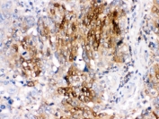 IHC testing of FFPE human lung cancer tissue with DARPP-32 antibody. HIER: Boil the paraffin sections in pH 6, 10mM citrate buffer for 20 minutes and allow to cool prior to staining.