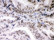 IHC testing of FFPE human intestinal cancer tissue with Daxx antibody. HIER: Boil the paraffin sections in pH 6, 10mM citrate buffer for 20 minutes and allow to cool prior to staining.