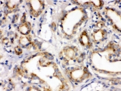 IHC testing of FFPE human prostate cancer tissue with FZD1 antibody. HIER: Boil the paraffin sections in pH 6, 10mM citrate buffer for 20 minutes and allow to cool prior to staining.