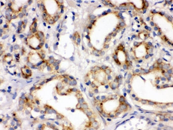 IHC testing of FFPE human prostate cancer tissue with FZD1 antibody. HIER: Boil the paraffin sections in pH 6, 10mM cit