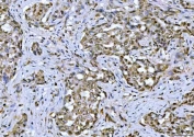 IHC staining of FFPE human lung adenocarcinoma tissue with TIF1 antibody. HIER: boil tissue sections in pH8 EDTA for 20 min and allow to cool before testing.