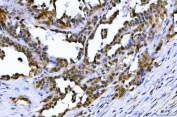 IHC staining of FFPE human ovarian serous adenocarcinoma tissue with TIF1 antibody. HIER: boil tissue sections in pH8 EDTA for 20 min and allow to cool before testing.