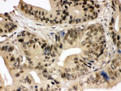 IHC testing of FFPE human intestinal cancer tissue with SMC3 antibody. HIER: Boil the paraffin sections in pH 6, 10mM citrate buffer for 20 minutes and allow to cool prior to staining.