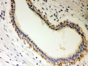 IHC testing of FFPE human breast cancer with STRAP antibody. HIER: Boil the paraffin sections in pH 6, 10mM citrate buffer for 20 minutes and allow to cool prior to staining.